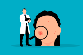 Acne giovanile e dell’adulto: cure, laser e impatto psicologico. Quando e come intervenire