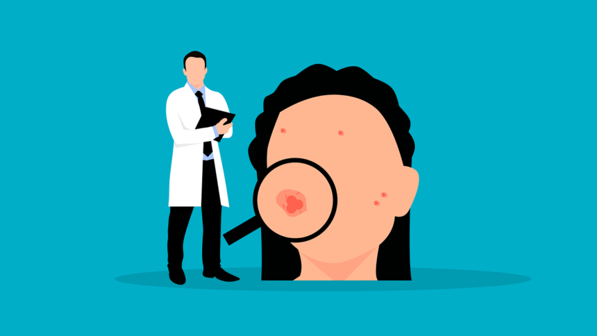 Acne giovanile e dell’adulto: cure, laser e impatto psicologico. Quando e come intervenire