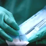 Tre interventi dopo estrazione dente del giudizio. Risarcimento da 205.000 euro